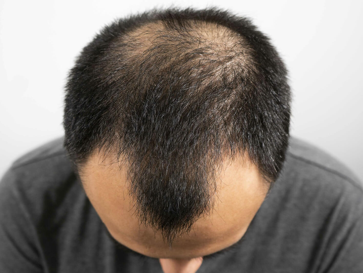 Alopecia areata treatment at ryan
